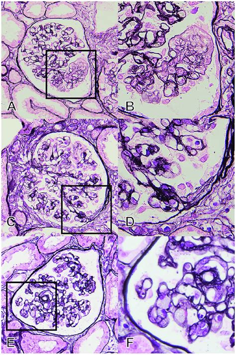 Pathological Findings In Patients Who Did Not Fit Any Of The Fsgs