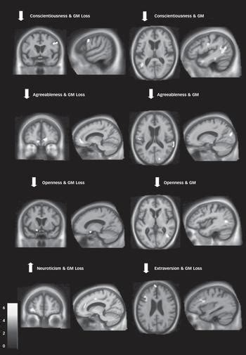 Neuroanatomical Profiles Of Personality Change In Frontotemporal Lobar