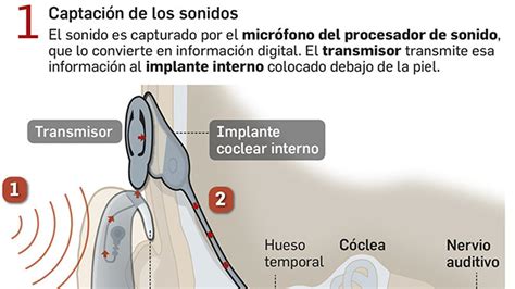 Video El Implante Coclear Un Antes Y Un Después En El Tratamiento De