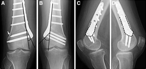 Medial Biplanar Closing Wedge Distal Femoral Osteotomy Using An | Hot ...