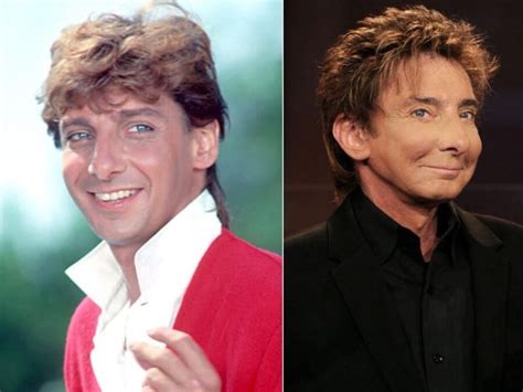 Barry Manilow Before And After Plastic Surgery Celebrity Plastic