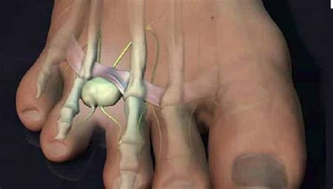 Neuroma De Morton Diagnostico Síntomas Y Tratamiento