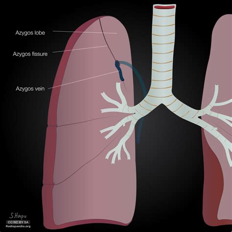 Radiopaedia Drawing Azygos Lobe English Labels Anatomytool