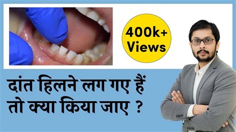 Tooth Mobility Treatment दांत हिलने के लक्षण कारण इलाज Loose