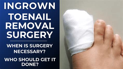 Ingrown Toenail Removal Before And After