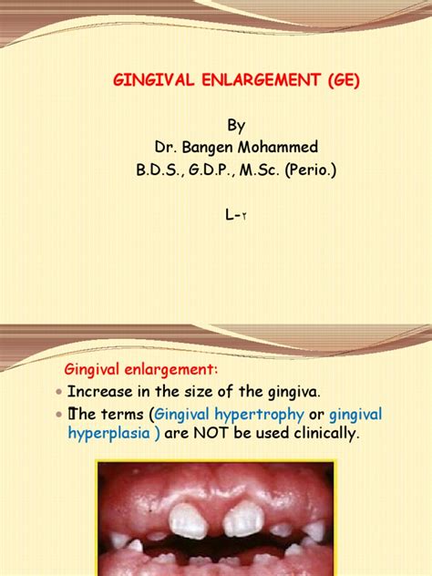 Classification And Etiology Of Gingival Enlargement A Comprehensive Review Pdf Dentistry