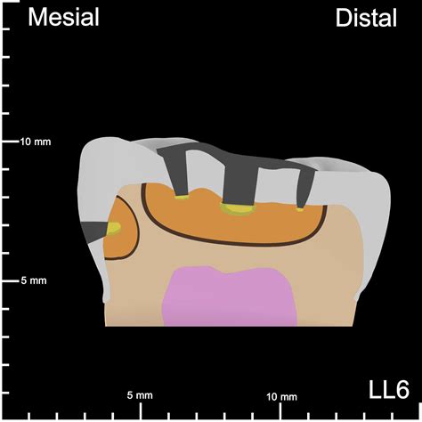 Ll Mesial And Occlusal Decay K Teeth