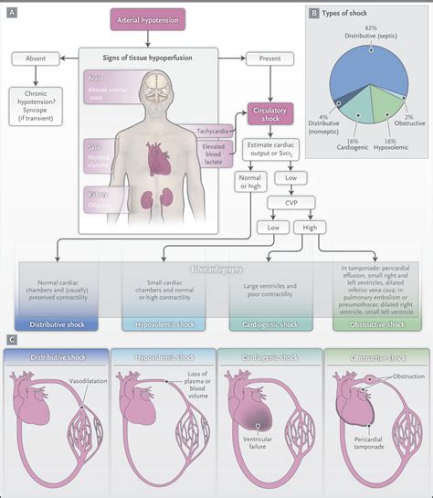 Circulatory Shock Nejm