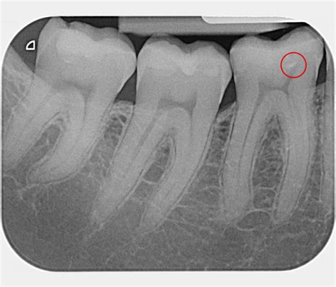 Wurzelkanalbehandlung Endodontologie Endodontie Bonn