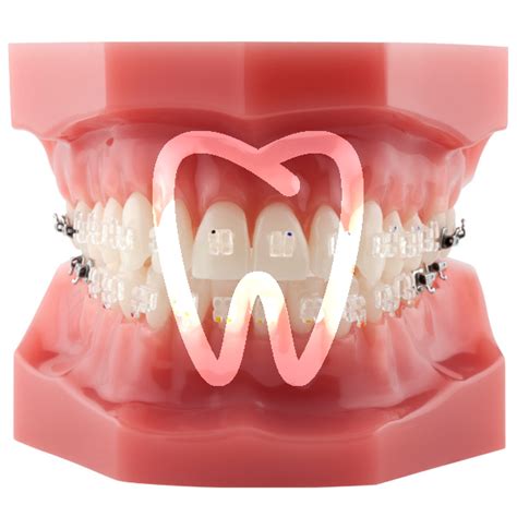 Broker Dental Modelo Roth Brackets Zafiro G Broker Dental