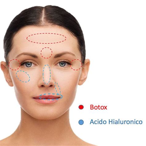 Diferencias Entre Botox Y Cido Hialur Nico Barcelona