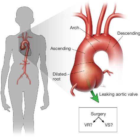 Figure 1 From Outcomes Of Aortic Root Replacement In Patients With