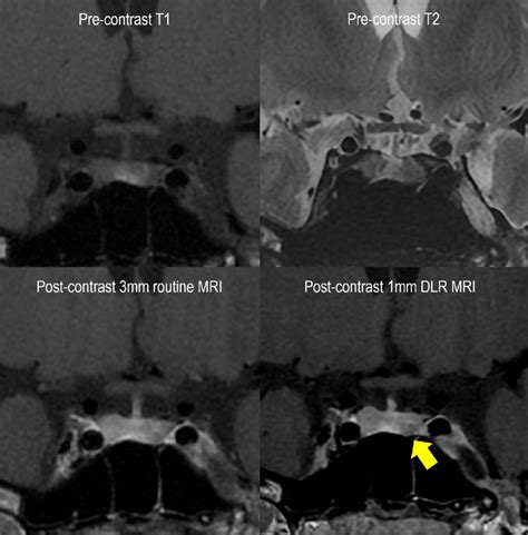 Representative Case Of Newly Detected Pituitary Microadenoma A