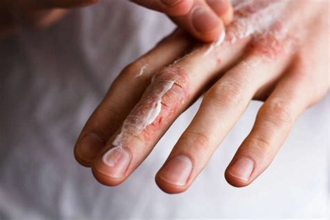 Rimedi Naturali Dermatite Da Freddo Non Sprecare