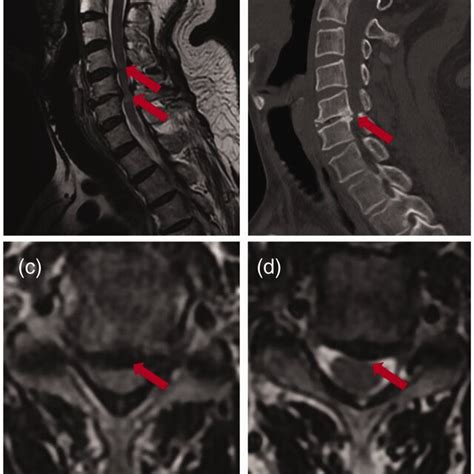 Preoperative Imaging Of The Cervical Spine A B C Magnetic