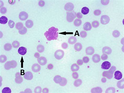 13 2 Leucemia Linfocítica Crónica CLL LibreTexts Español