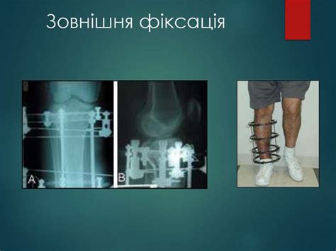 Закриті і відкриті переломи. Сучасні методи Лікування переломів ...