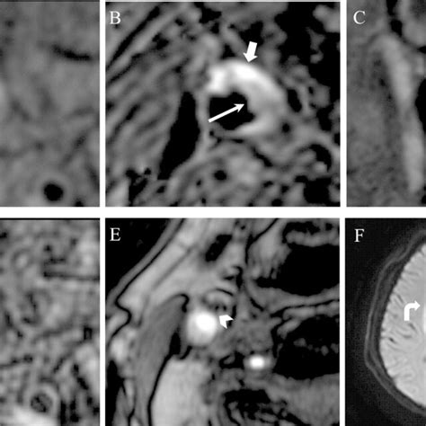 Patient Male 70 Years Old High Resolution Wall Imaging Of The