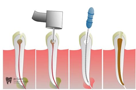 Endodoncija Lije Enje Zuba Stomatolo Ka Ordinacija Banja Luka