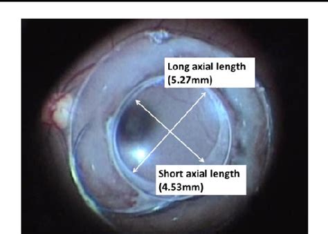 Figure 2 From Anterior Capsule Configuration And Surgical Technique In