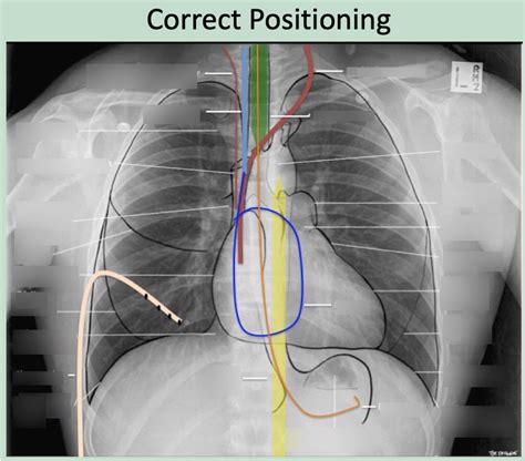 Diagnostic Imaging Exam 1 Medical Device Placements Diagram Quizlet