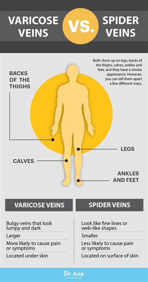 How To Get Rid Of Spider Veins Naturally In 2 Weeks Artofit