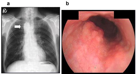 Lateral View Chest Anatomy Esophagus