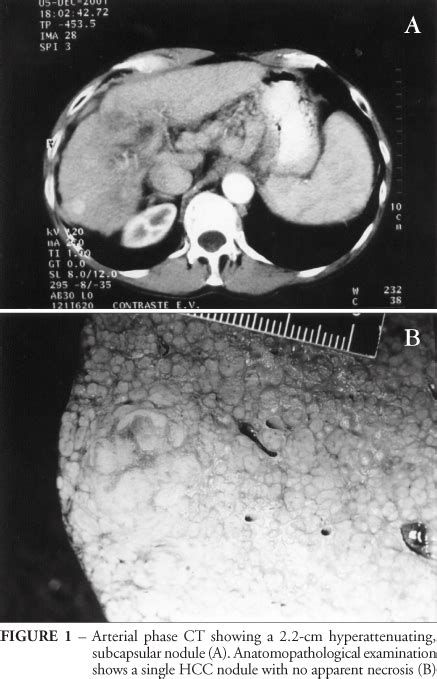 Scielo Brasil Hepatocellular Carcinoma In Patients Undergoing