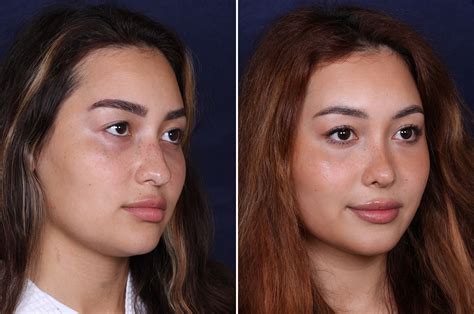 Rhinoplasty Photos Philadelphia Pa Patient 4079