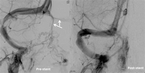 Case Archives Venous Pulsatile Tinnitus