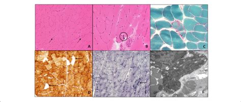 Muscle Biopsy Of Left Quadriceps H E Stained Frozen Section Of The