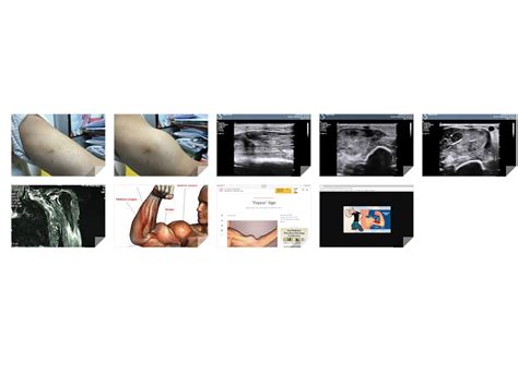 VIETNAMESE MEDIC ULTRASOUND: CASE 478: POPEYE’ SIGN of BICEPS MUSCLE ...