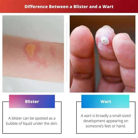 Blister Vs Wart Difference And Comparison