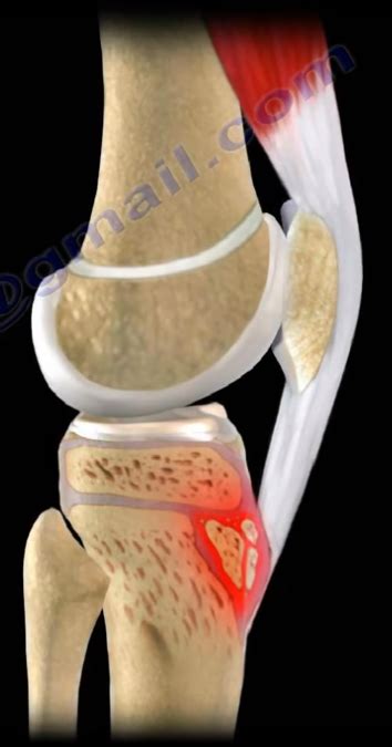 Growth Plates: Physis,Epiphysis, & Apophysis | by Nabil Ebraheim | Medium