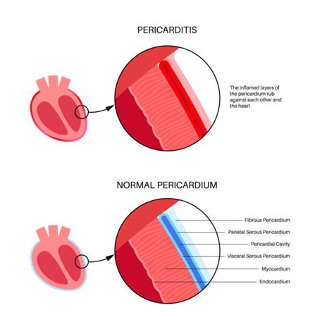 70 Pericarditis Illustrations Royalty Free Vector Graphics And Clip Art