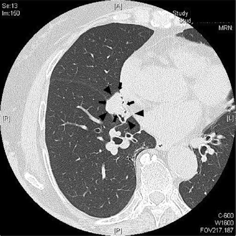 Chest Ct Showed A Solid 2 5 × 2 0 Cm Nodule In The Right Middle Lobe Download Scientific