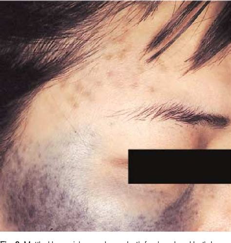 Figure 1 From Acquired Bilateral Nevus Of Ota Like Macules Abnom