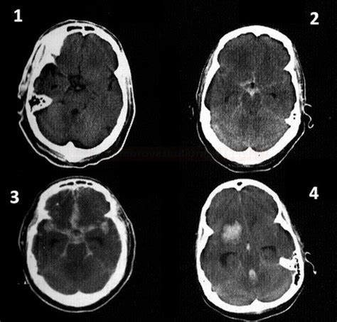 Subarachnoid Ln Krv Cen K Ly Cerebrovaskul Rn Manu L