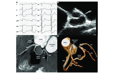 A Exercise Electrocardiogram B Transthoracic Echocardiography