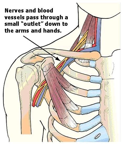 Thoracic Outlet Syndrom Is Helped By Neuromuscular Therapy