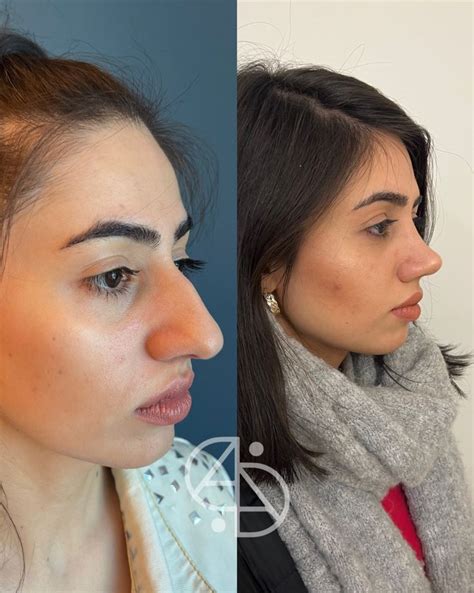 Rhinoplasty Result Dr Ahmet Dilber Rhinoplasty Plastic Surgery