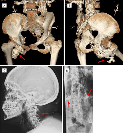 Ct Scan With D Reconstruction And Radiographs From Patient A Ct