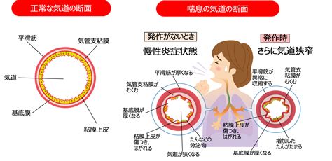 咳喘息気管支喘息｜秦野の内科・呼吸器内科【東海大学前駅クリニック】