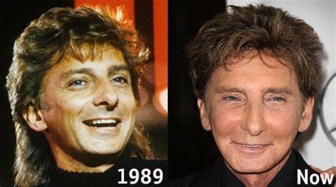 Barry Manilow Plastic Surgery Celebrity Plastic Surgery Online