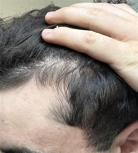 Minoxidil 3 Month Results Hairline Growing In R Minoxidil