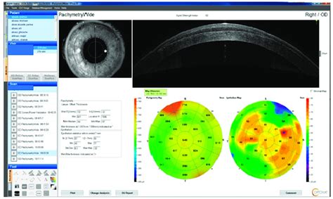 Comparison Of Epithelial Thickness Measurements Rtvue Sd Oct Device