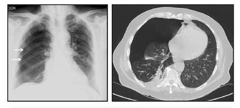 Revisión De Los Signos Radiológicos De Atelectasia Pulmonar Hallazgos