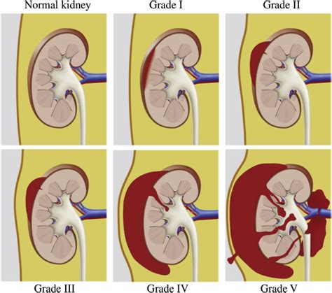 Renal Laceration Grading