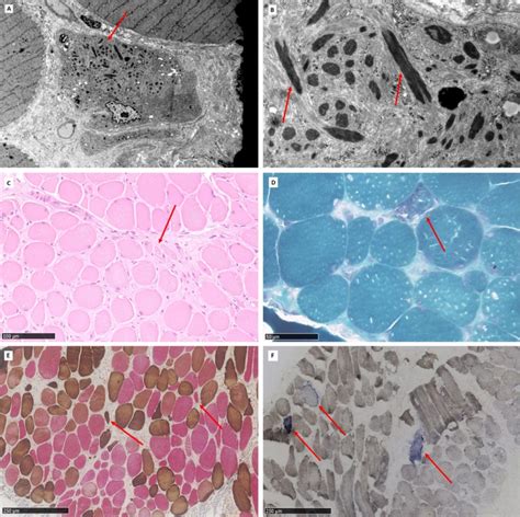 Muscle biopsy. A. Electron micrograph of skeletal muscle fibers. In the... | Download Scientific ...