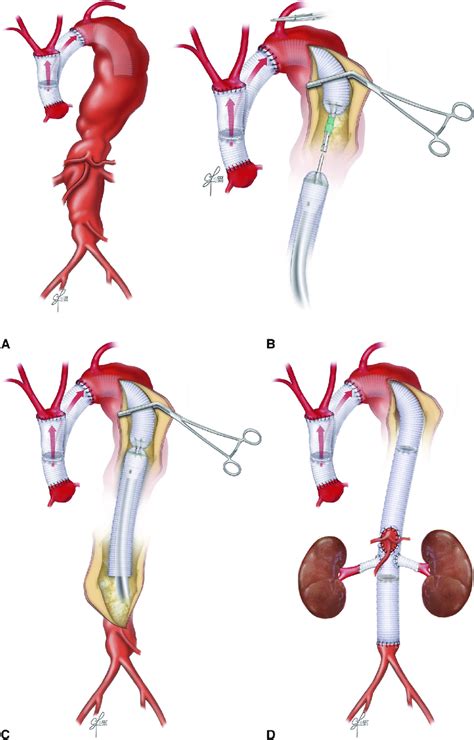 Demonstration Of The Use Of End To End Anastomotic Stapler In